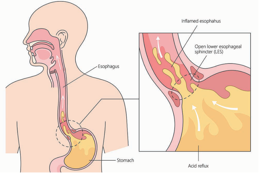 Medical University of South Carolina (Acid Reflux)