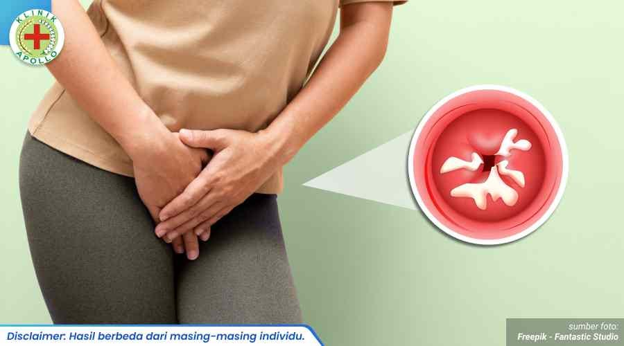 Tips Penyembuhan Penyakit Gonore Agar Lebih Optimal