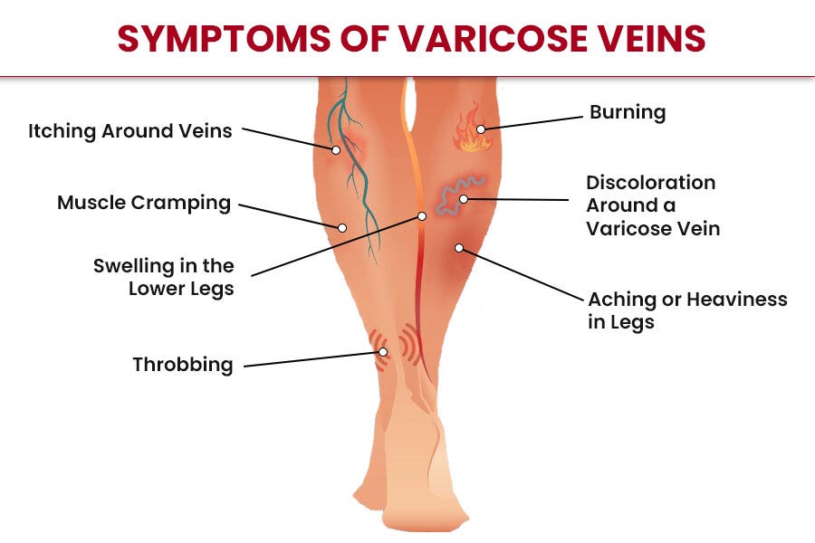 How are Varicose veins treated by an Interventional radiologist?, by Dr  Kunal Arora, Interventional Radiologist in Mum