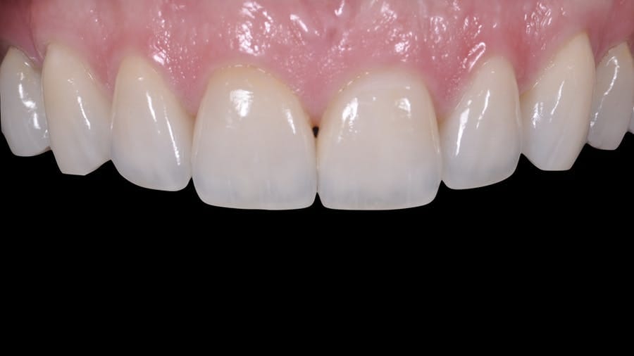 What To Do With Broken Dental Veneers? by Rani kumari Medium