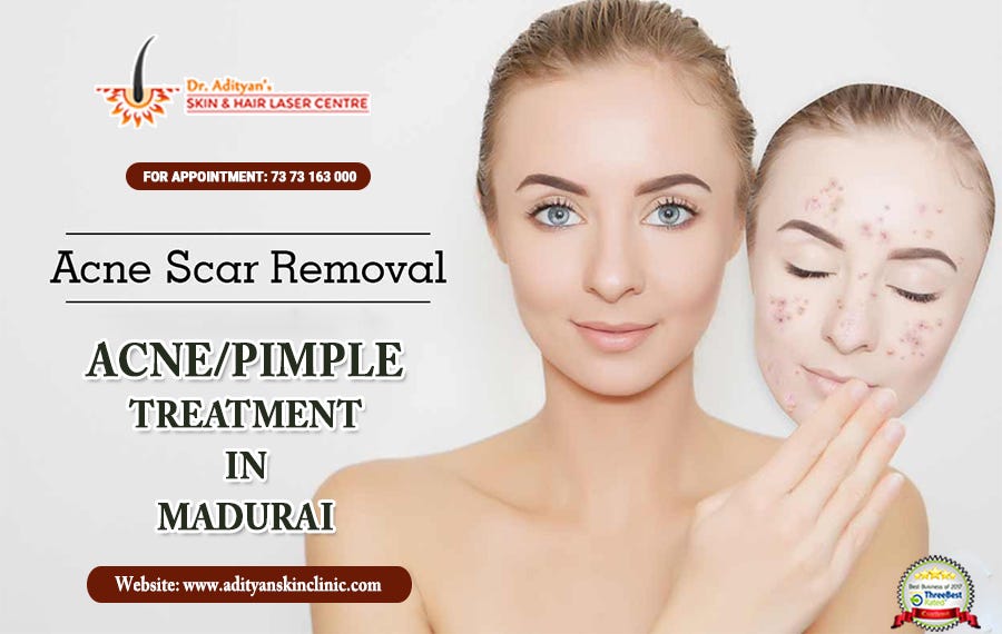 Acne/Pimple Scar Treatment — How to Cure Pimples in an Effective Way? by demardstarine Medium
