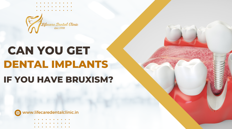 Can You Get Dental Implants If You Have Bruxism? by Life Care Dental