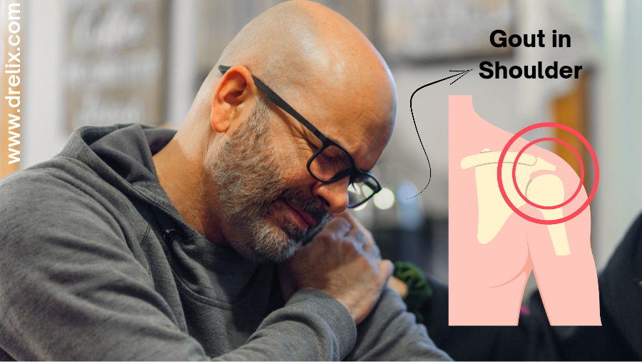 Gout in Shoulder Causes, Symptoms and Treatment by Dr. Elix Medium