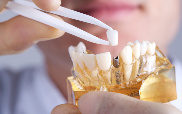 The Benefits of Cosmetic Dentistry: Why You Should Consider it