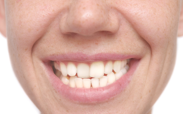 The Benefits of Cosmetic Dentistry: Why You Should Consider it