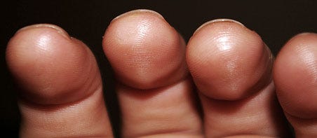 Guitar sore 2024 fingers super glue