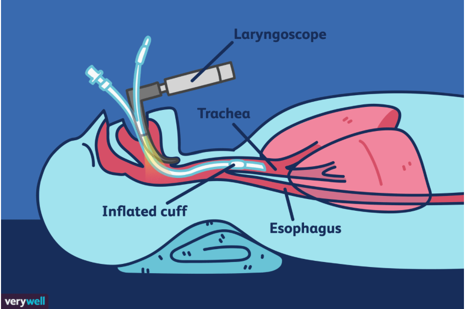 VeryWell (Illustration of Intubation)