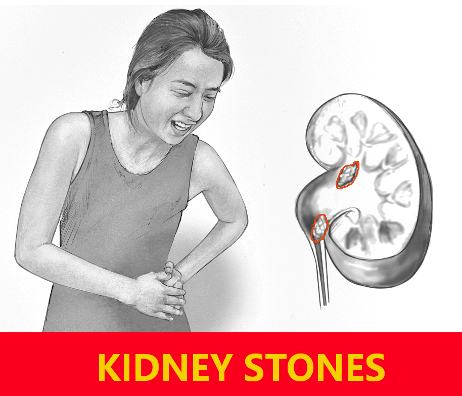 Home Remedies for Kidney Stones. • Drink plenty of warm water. by