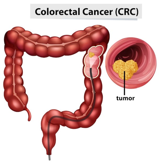 colonoscopy in Uttam Nagar, colonoscopy in Vikaspuri, colonoscopy in Dwarka, colonoscopy in Paschim Vihar, colonoscopy in North Delhi, or colonoscopy in Pitampura, Dr. Sawan Bopanna is one of the leading specialists offering comprehensive colonoscopy services in these regions.