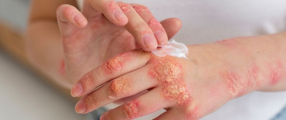Preview image for Fungal Infections on Skin: Causes, Symptoms, and Treatment