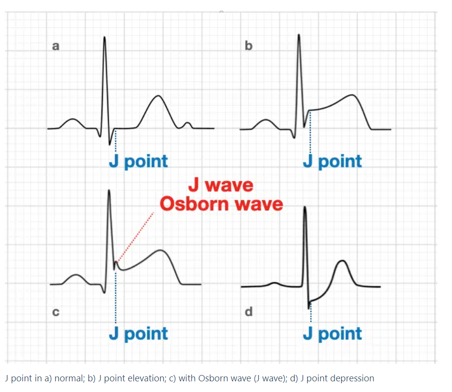 The J point in the ECG is the point where the QRS complex joins the ST
