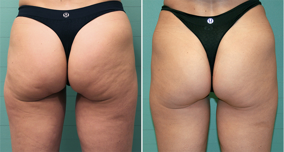 Instant cellulite removal. 2 Common Exercises That Will Shred the…, by  skinfirming cream