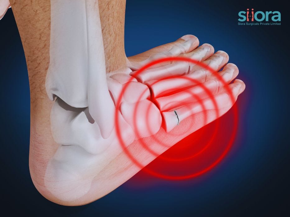 An Expert Guide to Avulsion Fractures Siiora Surgical Medium