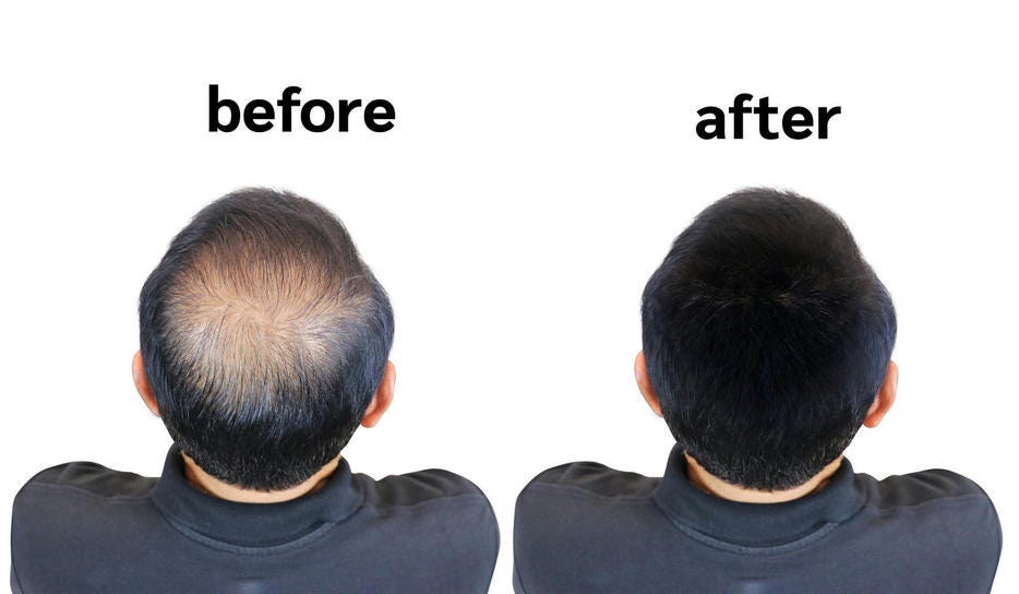 Hair patches shop for men