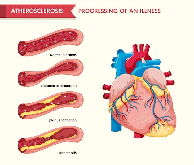 Understanding Atherosclerosis: Causes, Symptoms and Treatment