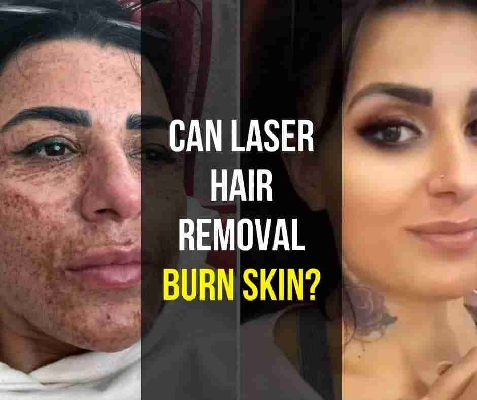 Can laser hair removal burn skin by GGreat Mar 2024 Medium