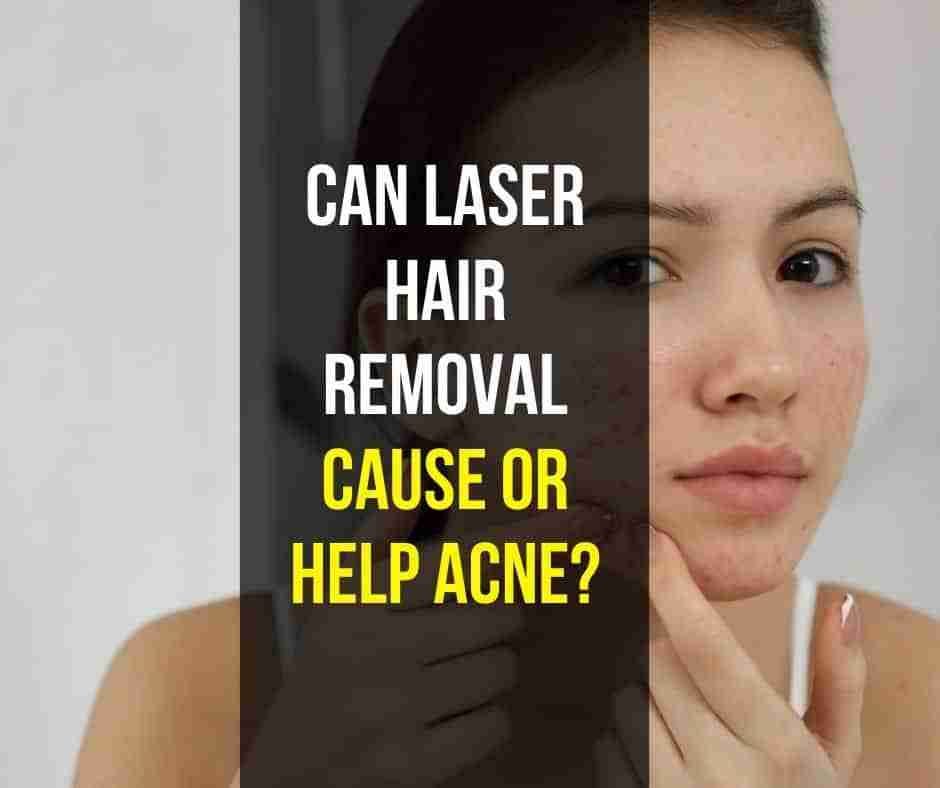 Can Laser hair removal cause or help acne? by GGreat Mar, 2024 Medium