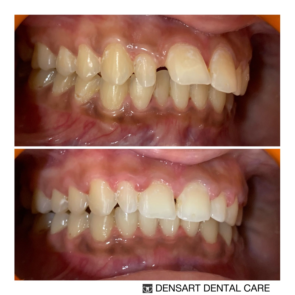 Orthodontist in Sinhagad Road, Pune by Dentalclinicdensart Medium