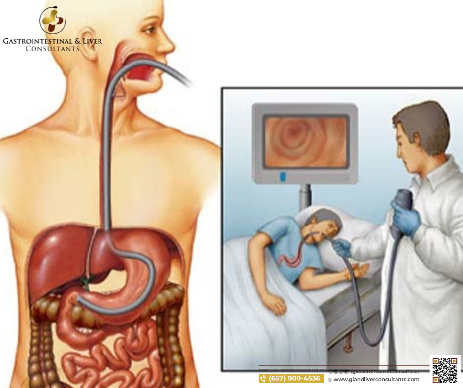 EGD Test (Esophagogastroduodenoscopy) by Dr Essam Medium