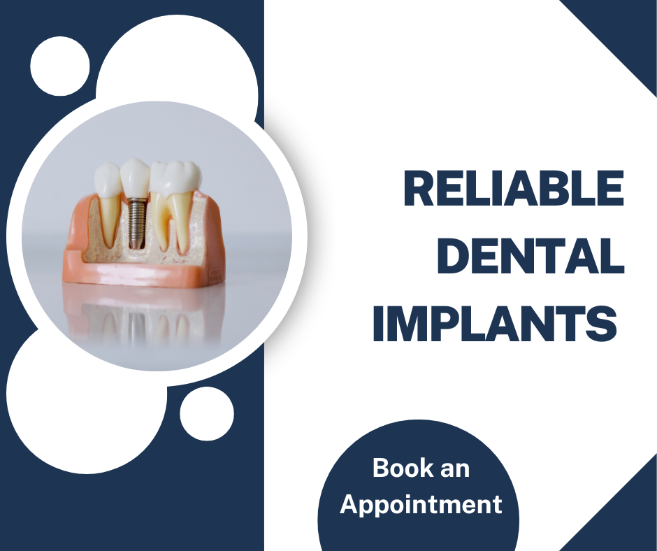 Exploring the Benefits of Dental Implants for Oral Health by Goodna