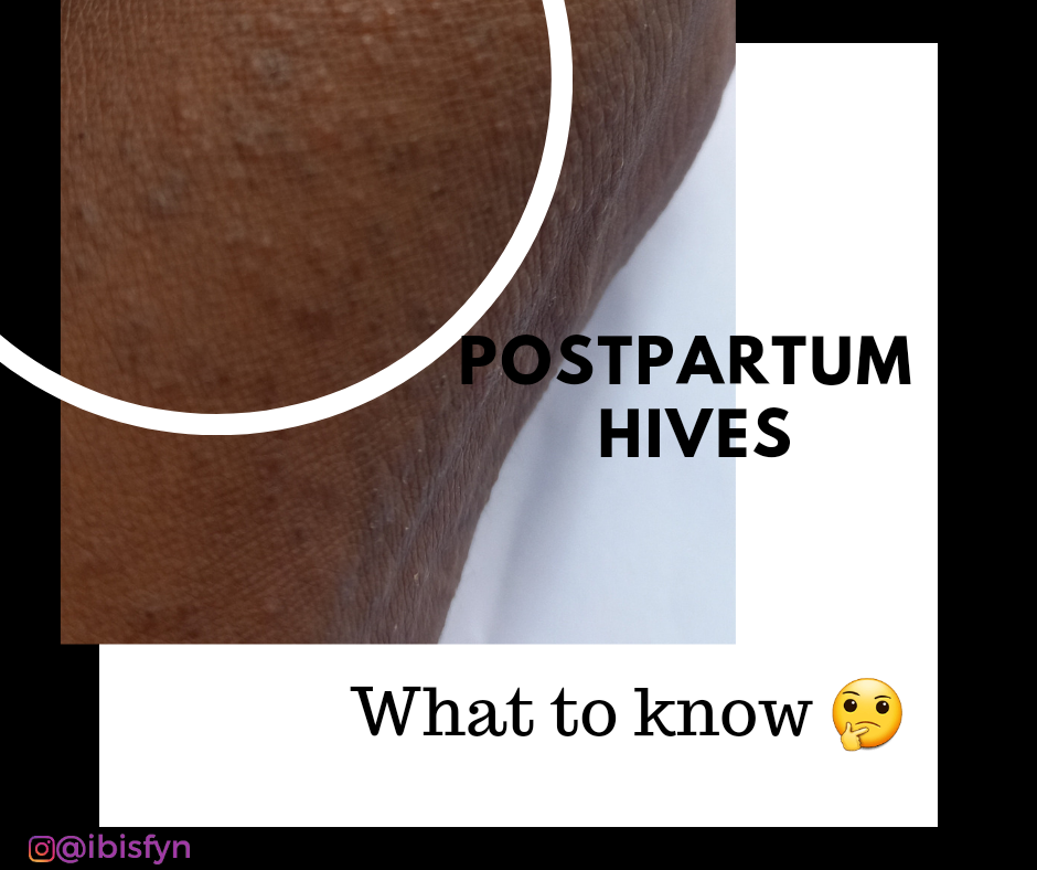 I CAN'T STOP ITCHING AFTER DELIVERY, HELP!!! by Ibiwarigm Medium