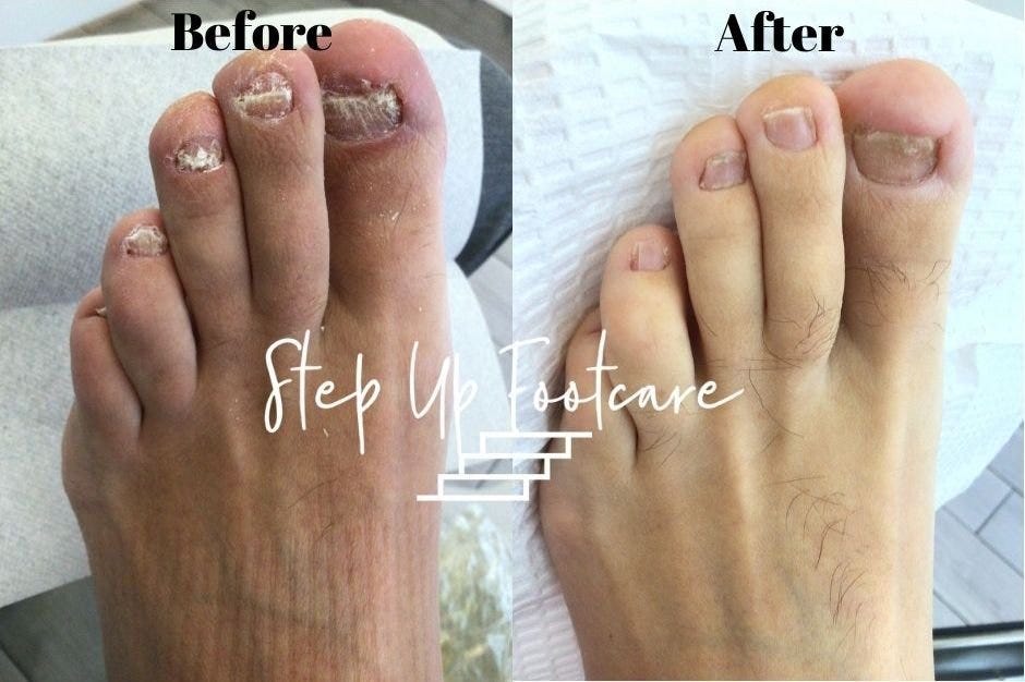 REAL cause of Toenail fungus revealed and How to Eliminate it in less