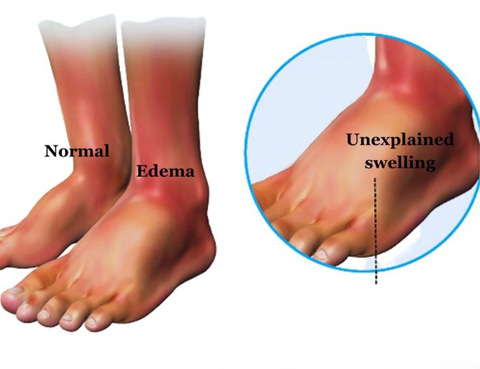 Body Swelling — Causes, Symptoms, and Diagnosis