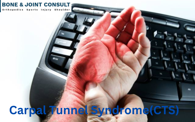 Carpal Tunnel Syndrome