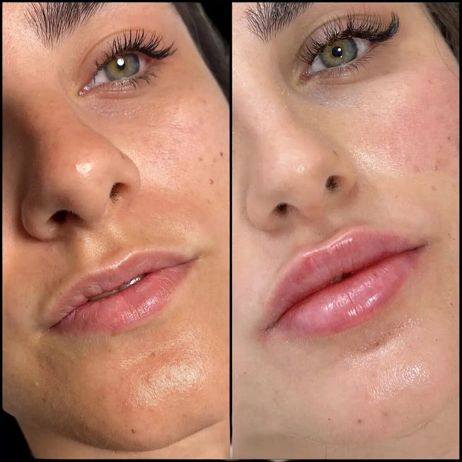 Fillers in Dubai