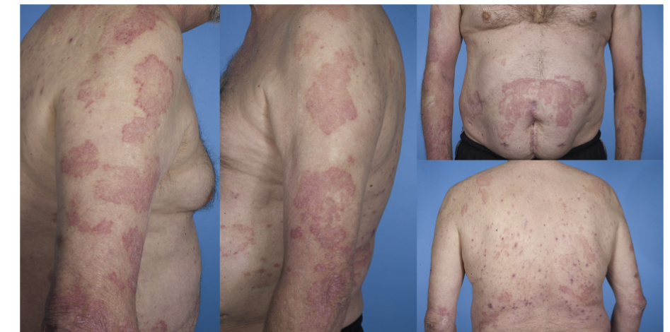 Side Effects of Methotrexate Therapy for Psoriasis
