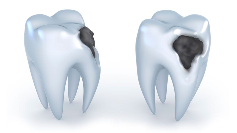 The best ways by dr george hanna dentist to prevent tooth decay by