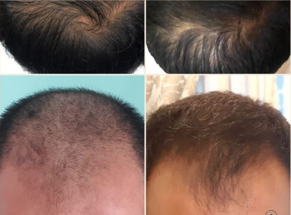 All you wanted to know about hair loss in men by Alfred Ibrahim Medium