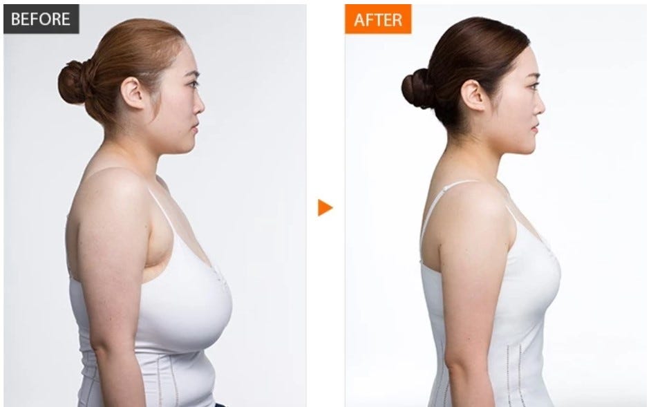 How Much Does Breast Reduction Surgery Cost in India Plastic Surgery