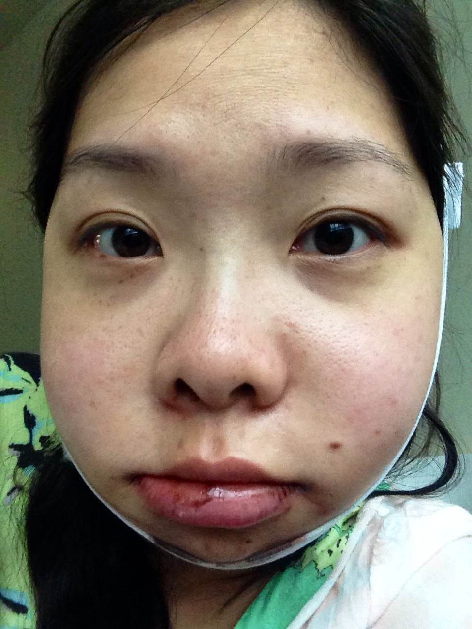 Day 2 of Double Jaw Surgery Recovery by Rui Bai Medium