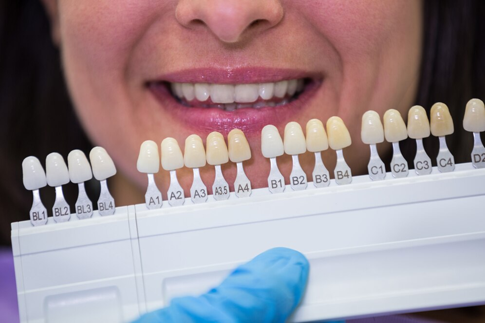 3 Signs Your Dental Veneers Need Replacing by Eliasediaz Official