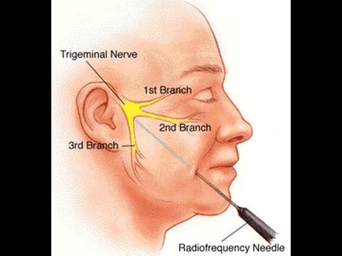 Trigeminal Neuralgia Treatment: Get rid of the agonising pain with help of  Botox therapy | by Pain Clinic Of India