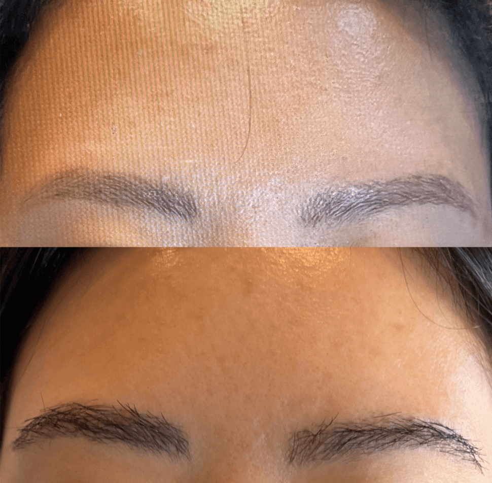 Eyebrow Transplant in Montreal. The eyebrow industry has never been