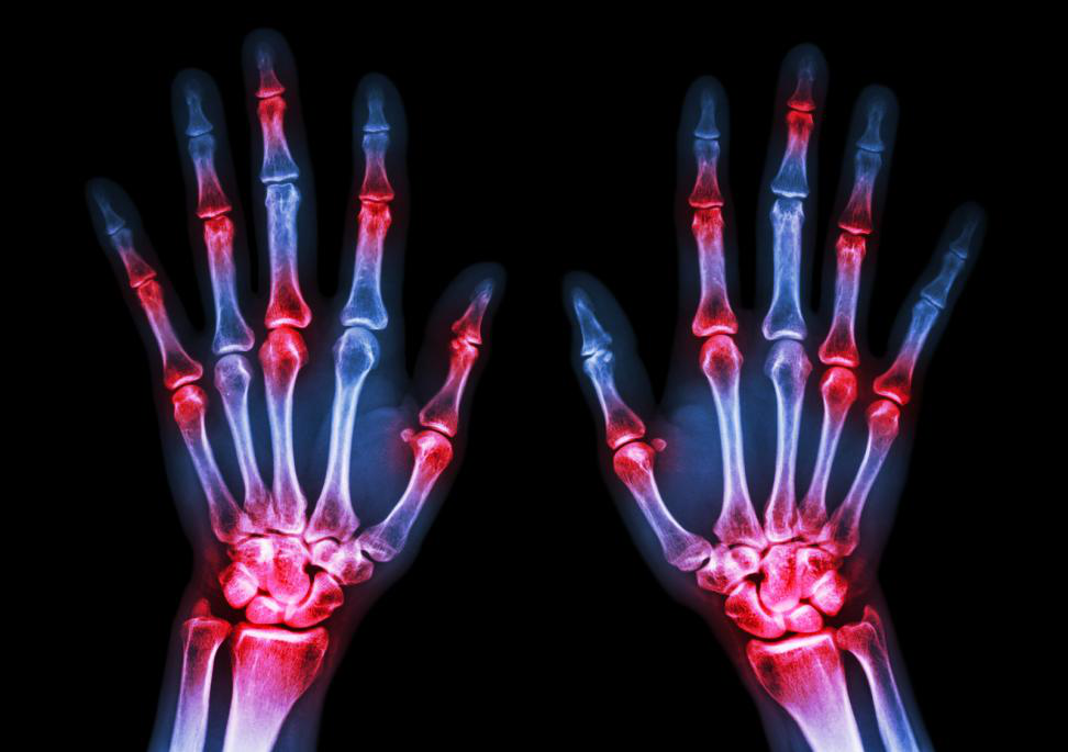 Things You Need To Know About Advanced Rheumatoid Arthritis Treatment by Urgent Care East