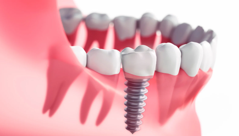 How Long Does It Take for Dental Implant Surgery to Heal? by