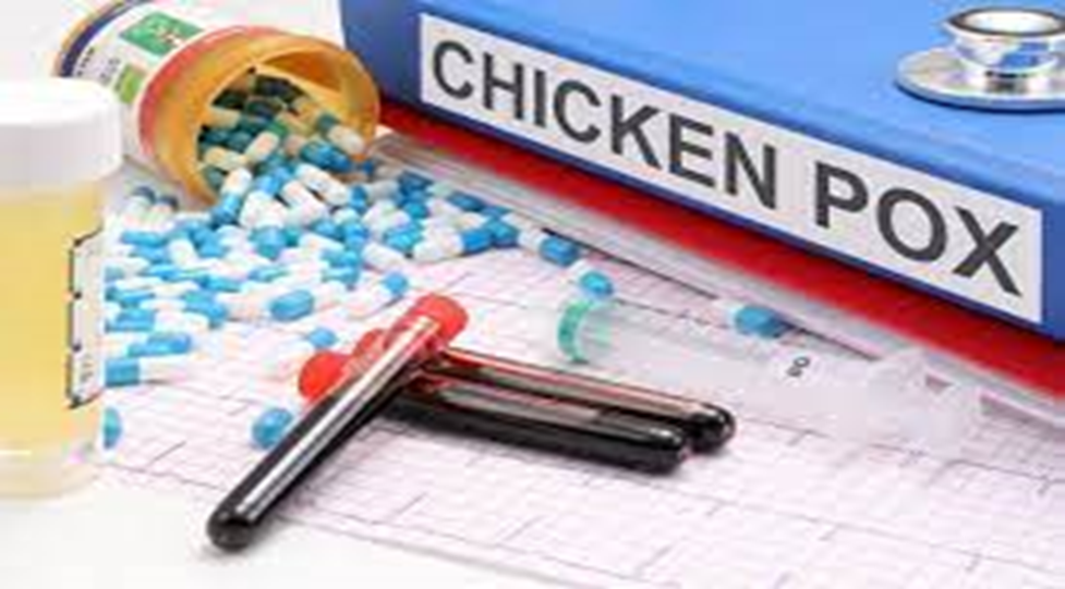 Chicken pox- A Contagious Disease