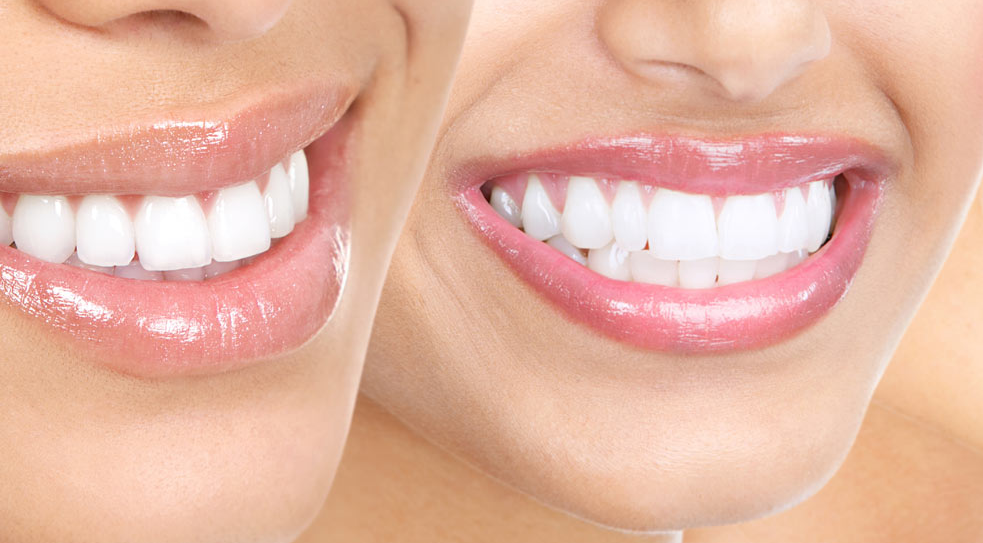 Cosmetic Dentist Acton. Not happy with an own smile because of… by