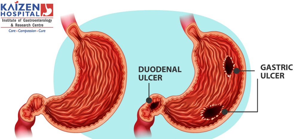 Managing Stomach Ulcers In The Duodenum Effective Treatment Strategies Kaizen Hospital Medium