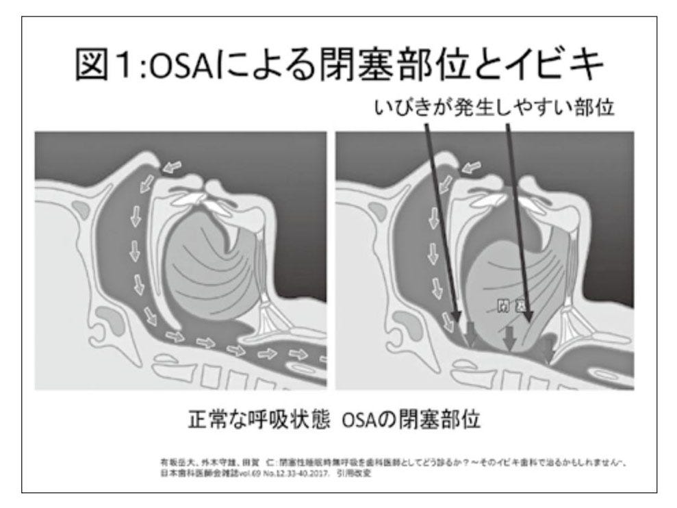 睡眠と口腔機能（２）. 「閉塞性睡眠時無呼吸OSAに対する歯科の役割 