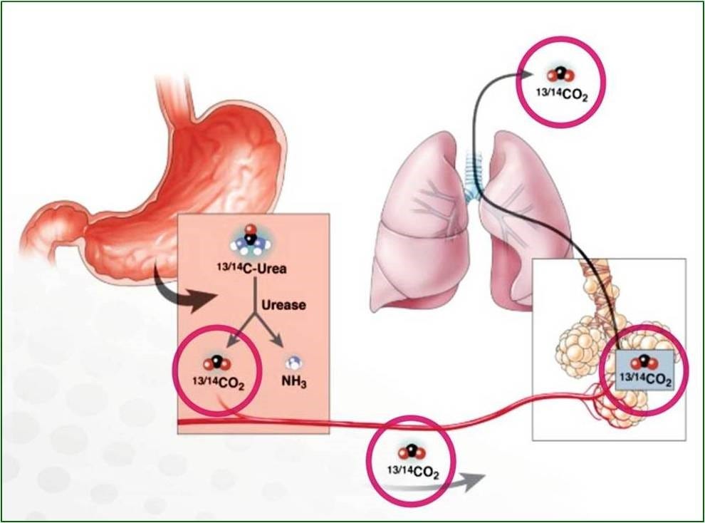 Urea Breath Test is used to detect Helicobacter pylori (H. pylori), a
