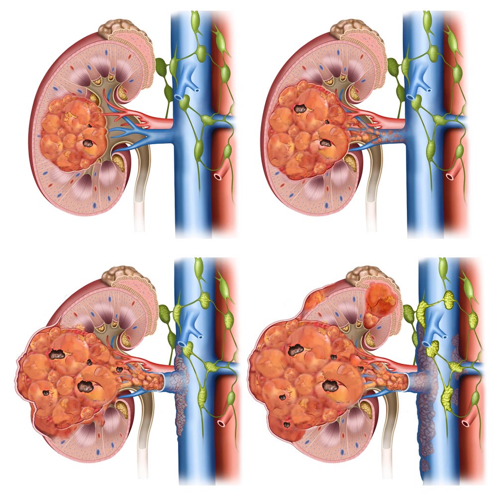 How To Reduce Creatinine, Improve Kidney Function, and Avoid Dialysis