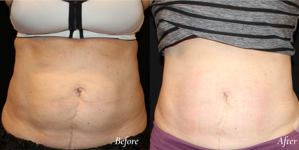 Body Contouring After Weight Loss Transforming Bodies and Lives by